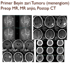 beyin-tumoru-1