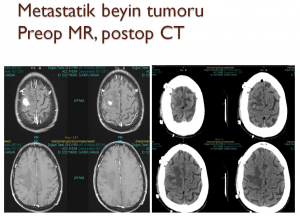 beyin-tumoru-2